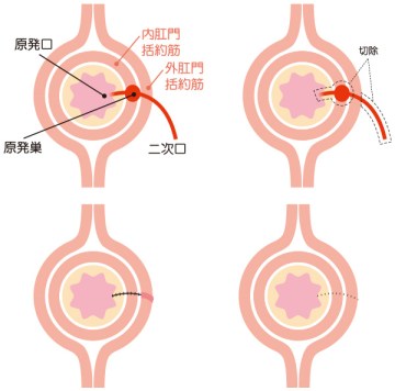 くり抜き法