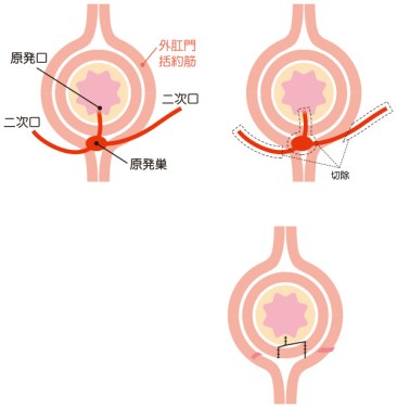 切開開放術