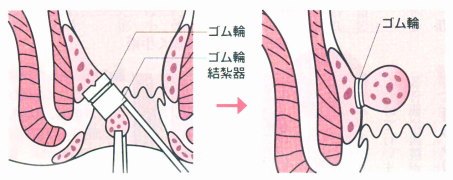 輪ゴム結紮術