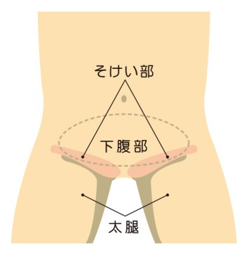 鼠径ヘルニア